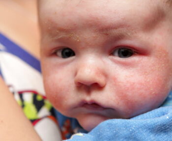 Baby Eczema Care Routine