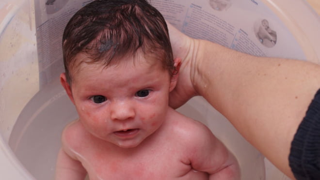 Best Baby Eczema Creams