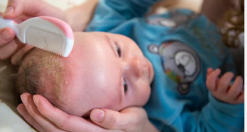 Soothing Cradle Cap Massage