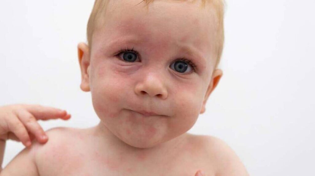 Baby Hives Symptom